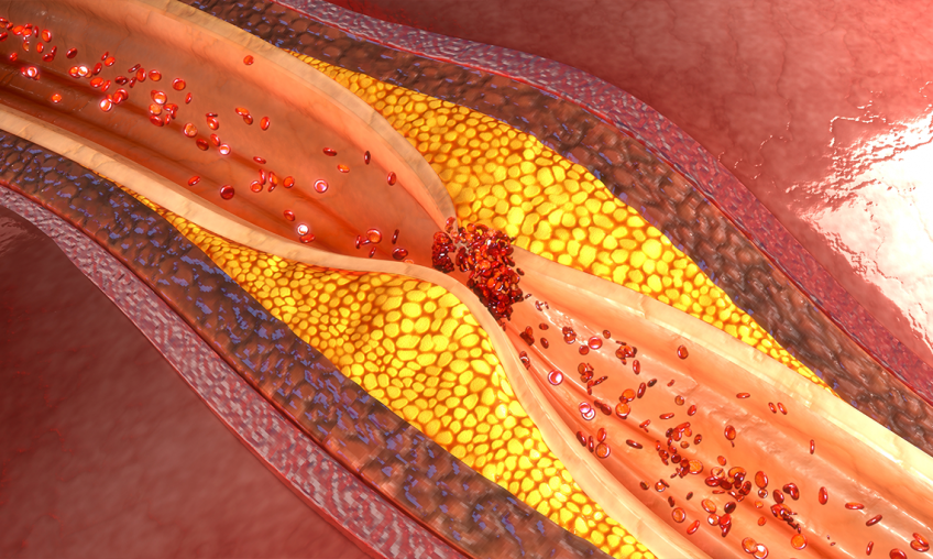 Cholesterol - ako udržiavať jeho zdravú hladinu?